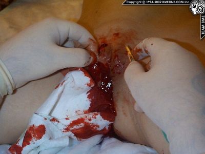 Robyn-labiacut-fgm-female-circumcision-bloody-019