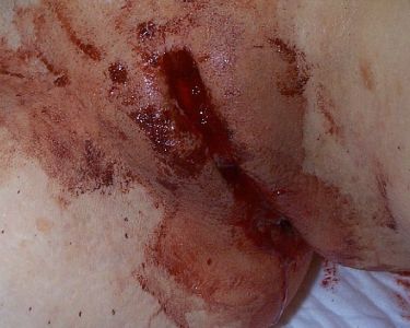 Robyn-labiacut-fgm-female-circumcision-bloody-026