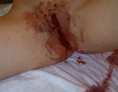 Robyn-labiacut-fgm-female-circumcision-bloody-027