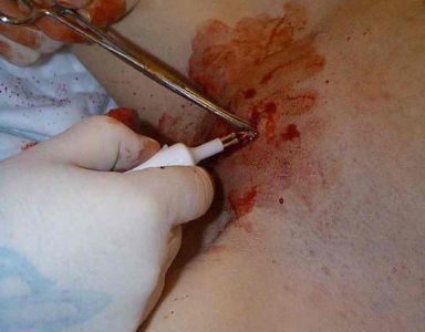 Robyn-labiacut-fgm-female-circumcision-bloody-028
